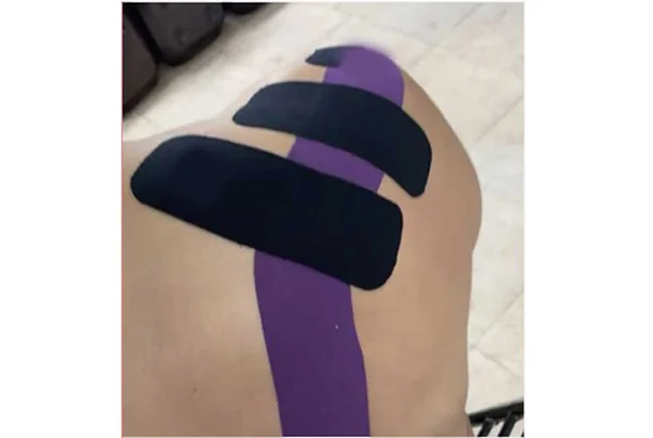 Kinesio Taping