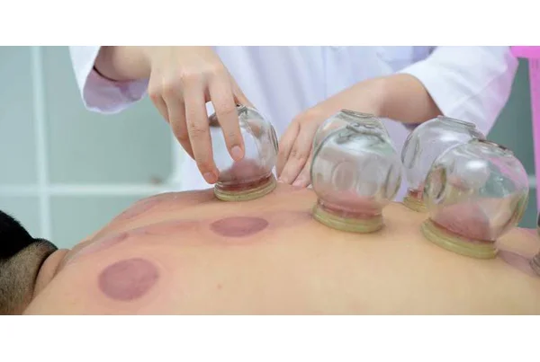 Cupping Therapy