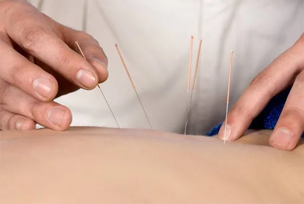 Dry Needling Therapy